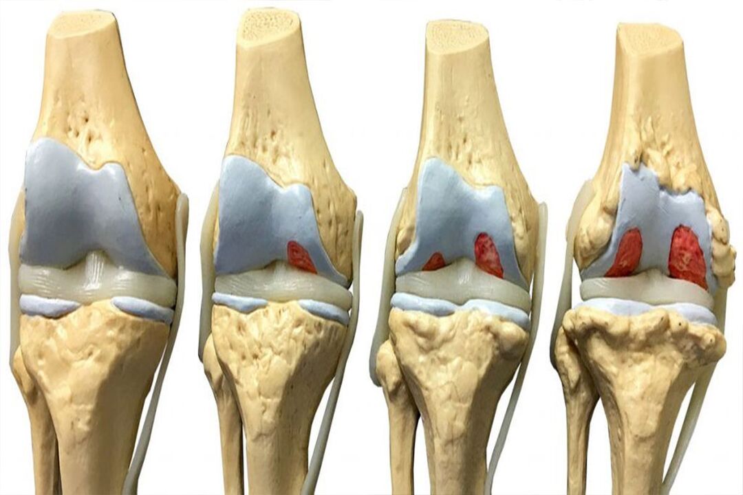 tahapan ngembangkeun arthrosis