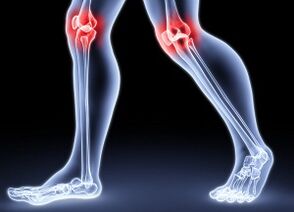 Alesan pikeun ngembangkeun dengkul arthrosis