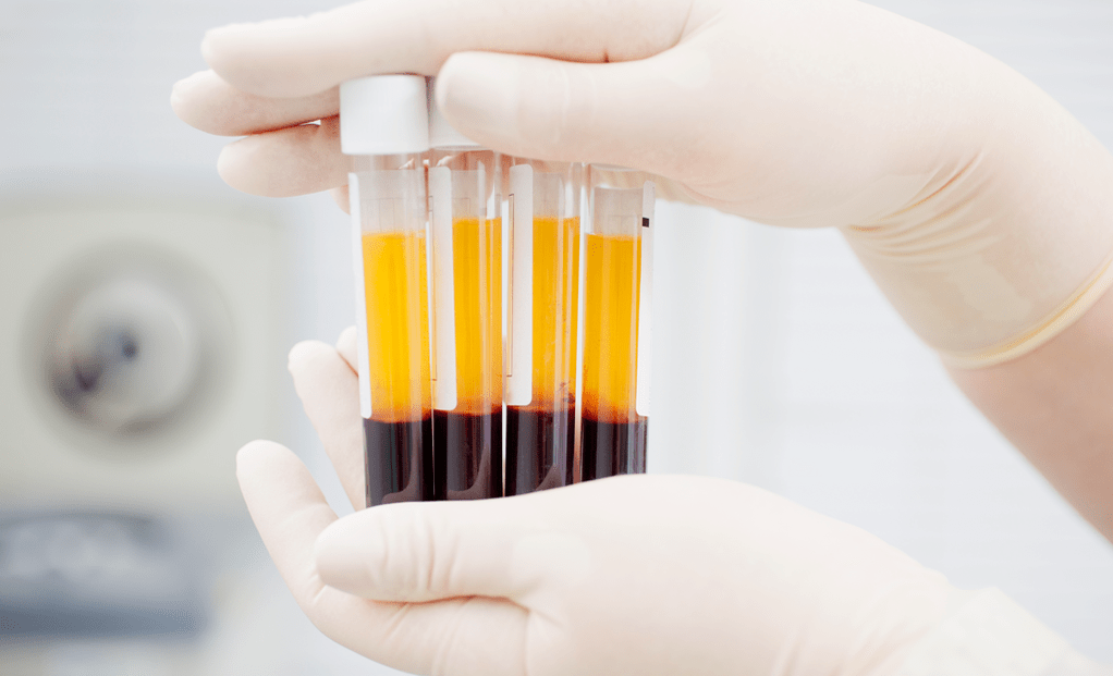 Plasma anu beunghar trombosit pikeun terapi PRP pikeun arthrosis