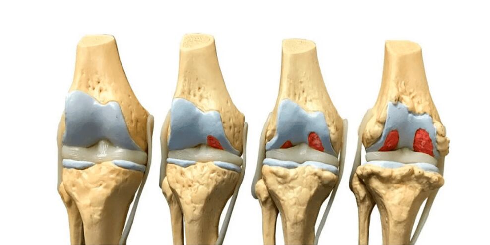 derajat arthrosis tina sendi